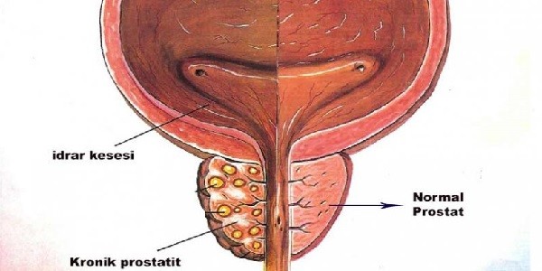 Prostatit-Nedir