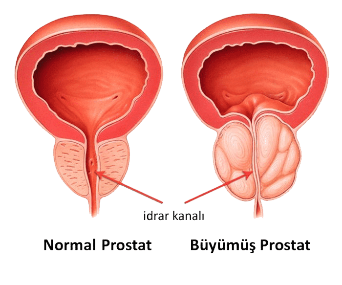 buyumus-prostat