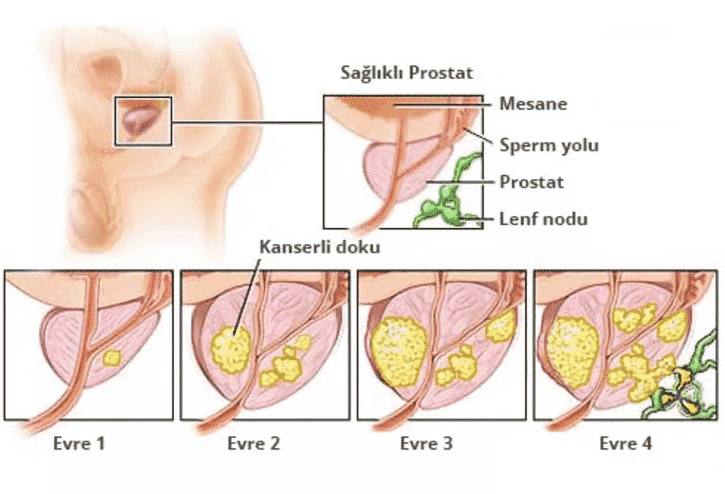 prostat-kanseri-tedavisi