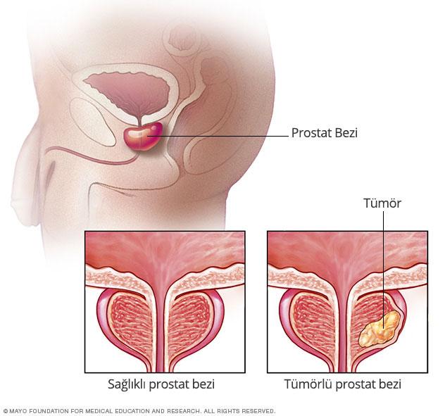 prostat-kanseri