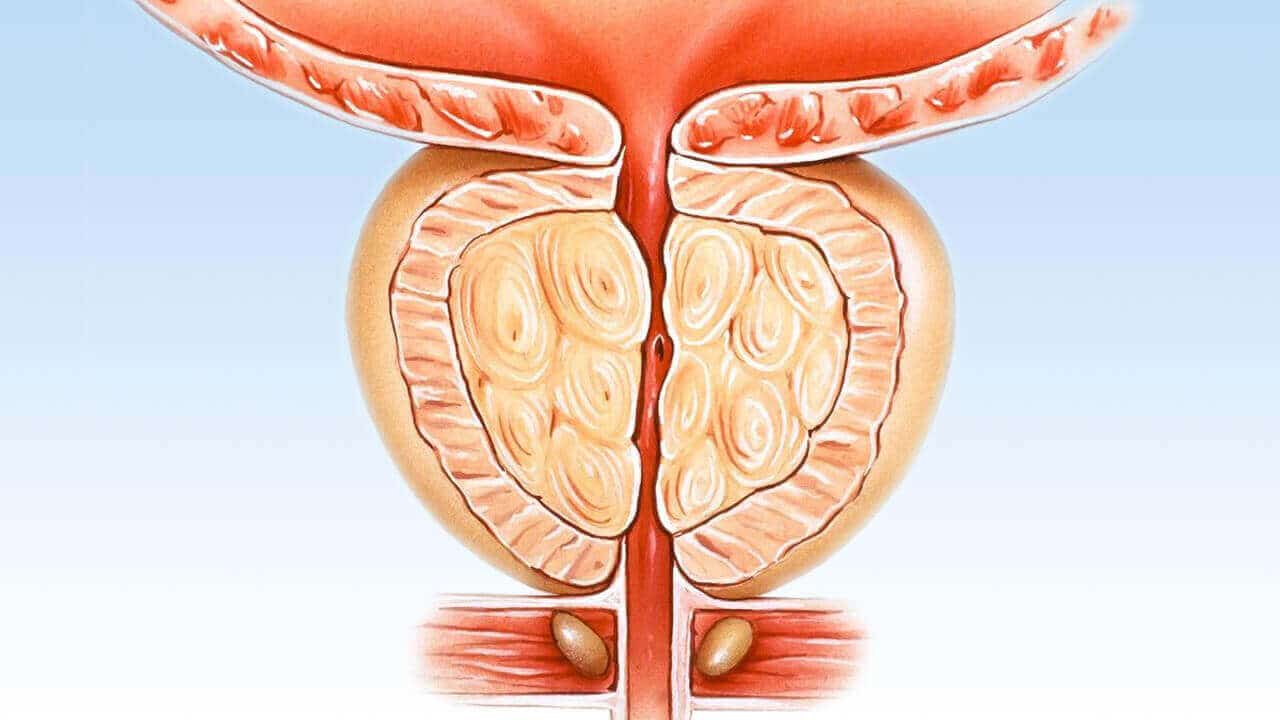 prostat tedavisi