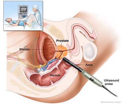 prostatit-tedavisi