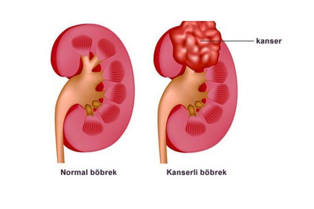 böbrek tümörü tedavisi