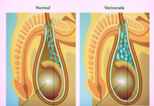 Varikosel